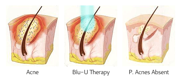 Blu-U Therapy