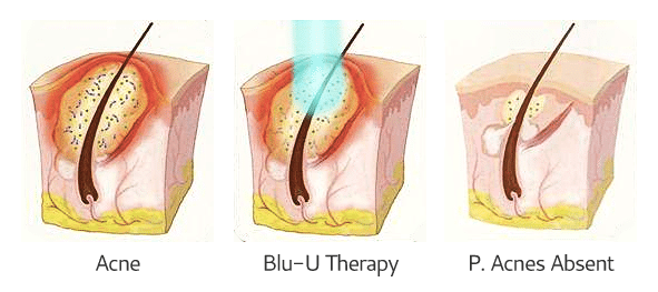 Blue Light Siperstein Dermatology Group