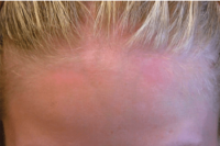 psoriasis - after xtrac treatment