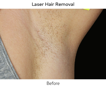laser hair removal - before