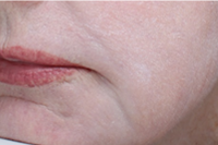 laser skin resurfacing - after