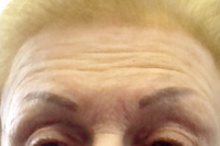 botox - before