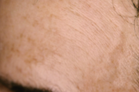 photofacial before