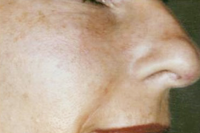 photofacial before