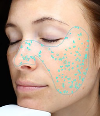 visia skin analysis