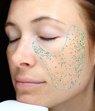 visia skin analysis