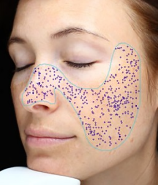 visia skin analysis