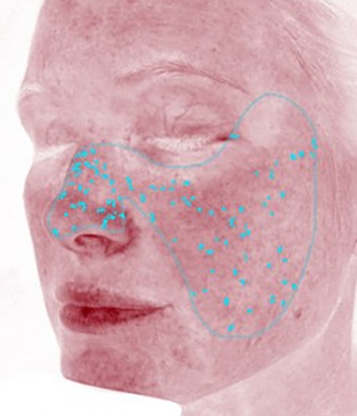 visia skin analysis