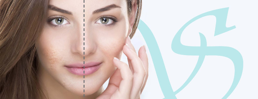 adult acne