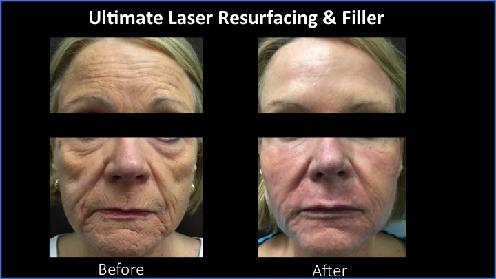 Ultimate Laser Resurfacing and Filler