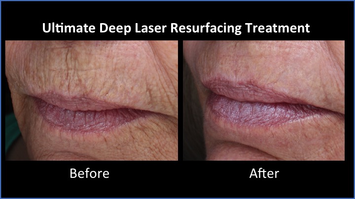 Ultimate Deep Laser Resurfacing Treatment