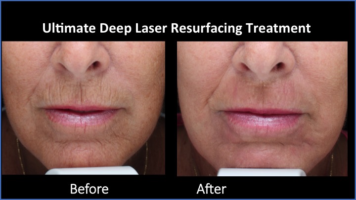 Ultimate Deep Laser Resurfacing Treatment