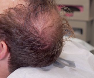 photo of patient with hair loss