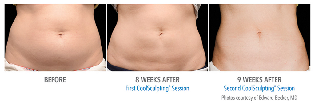 CoolSculpting: Safe, Non-invasive Fat Removal Treatment