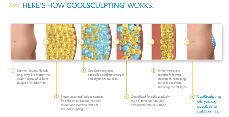 how-coolsculpting-works