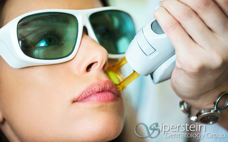 laser hair removal