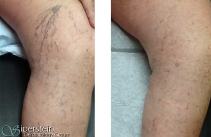 sclerotherapy