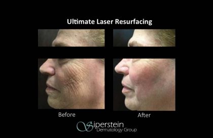 laser-skin-resurfacing