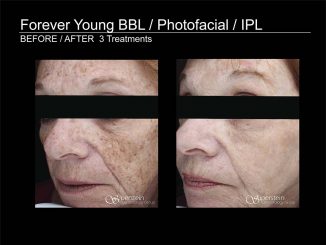 Forever Young BBL / IPL / Photofacial