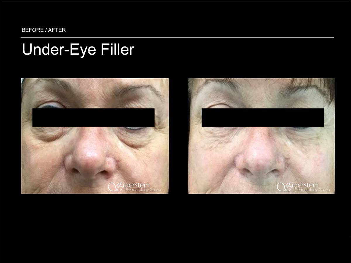 under eye filler before and after
