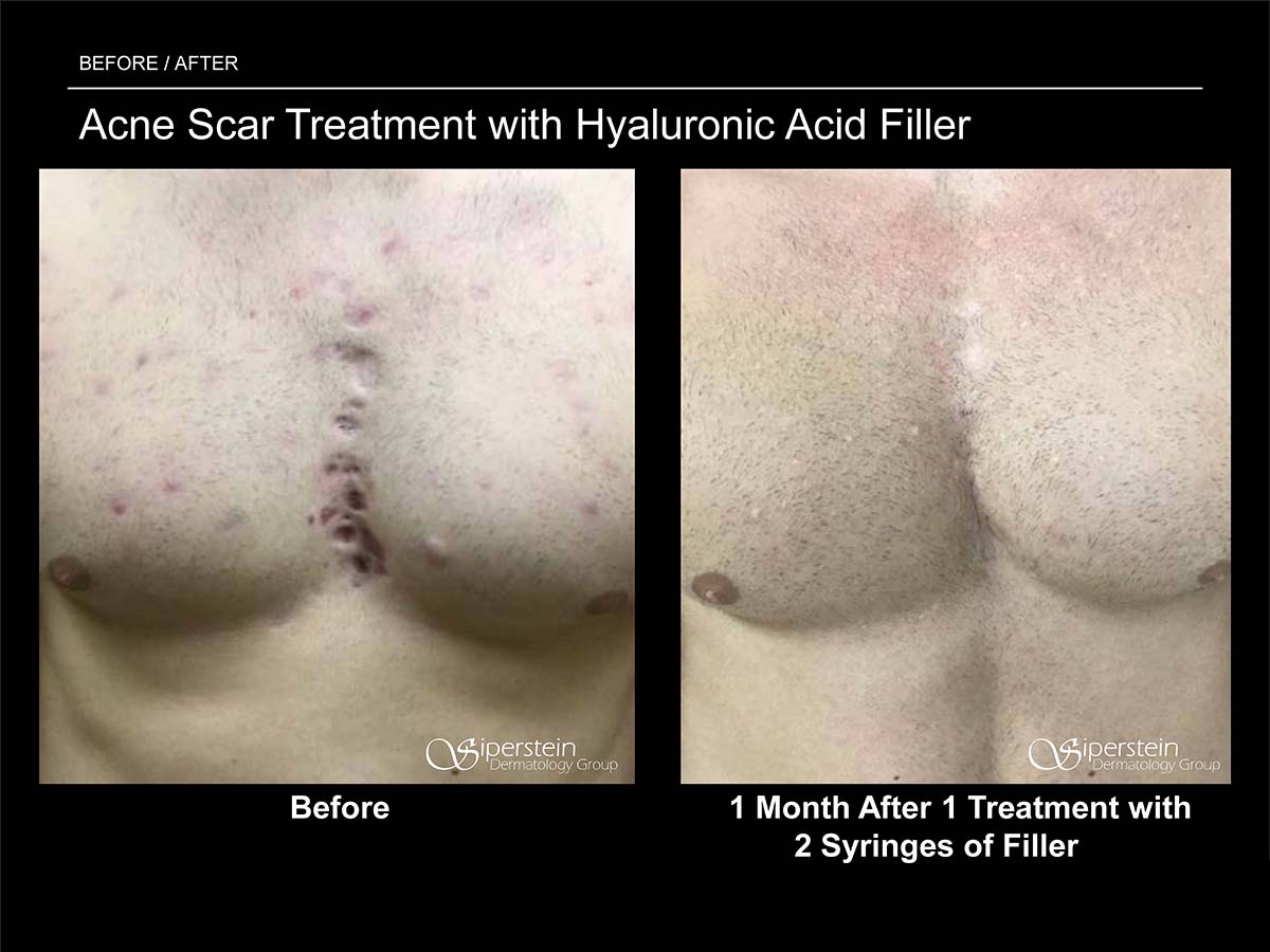 acne scar treatment with hyaluronic acid filler