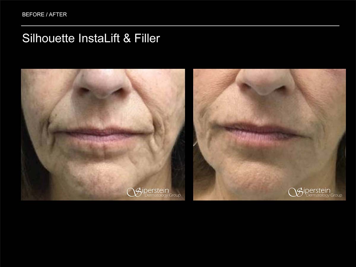 silhouette lift and filler around mouth