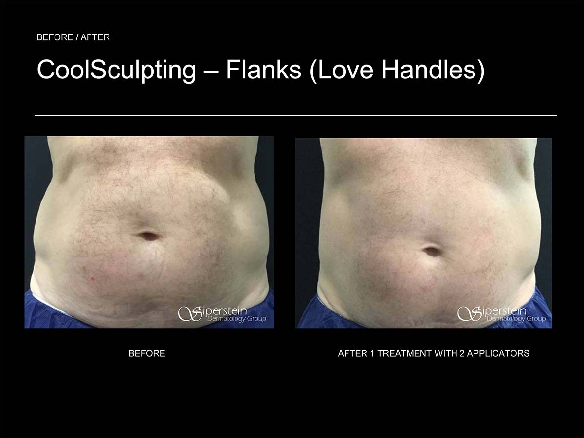 CoolSculpting - Upper & Lower Flanks Before & After Gallery - Case 4437