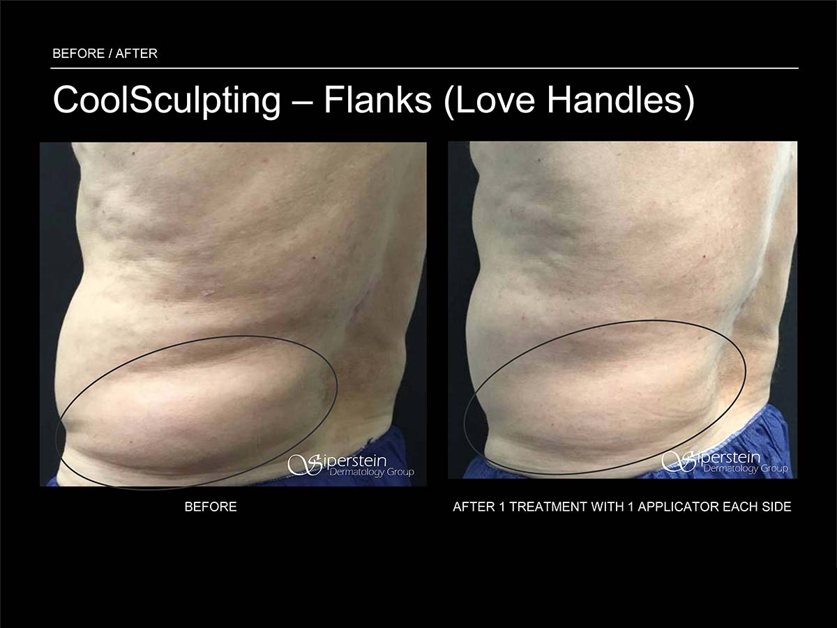 CoolSculpting Love Handles, Coolsculpting flanks before and after