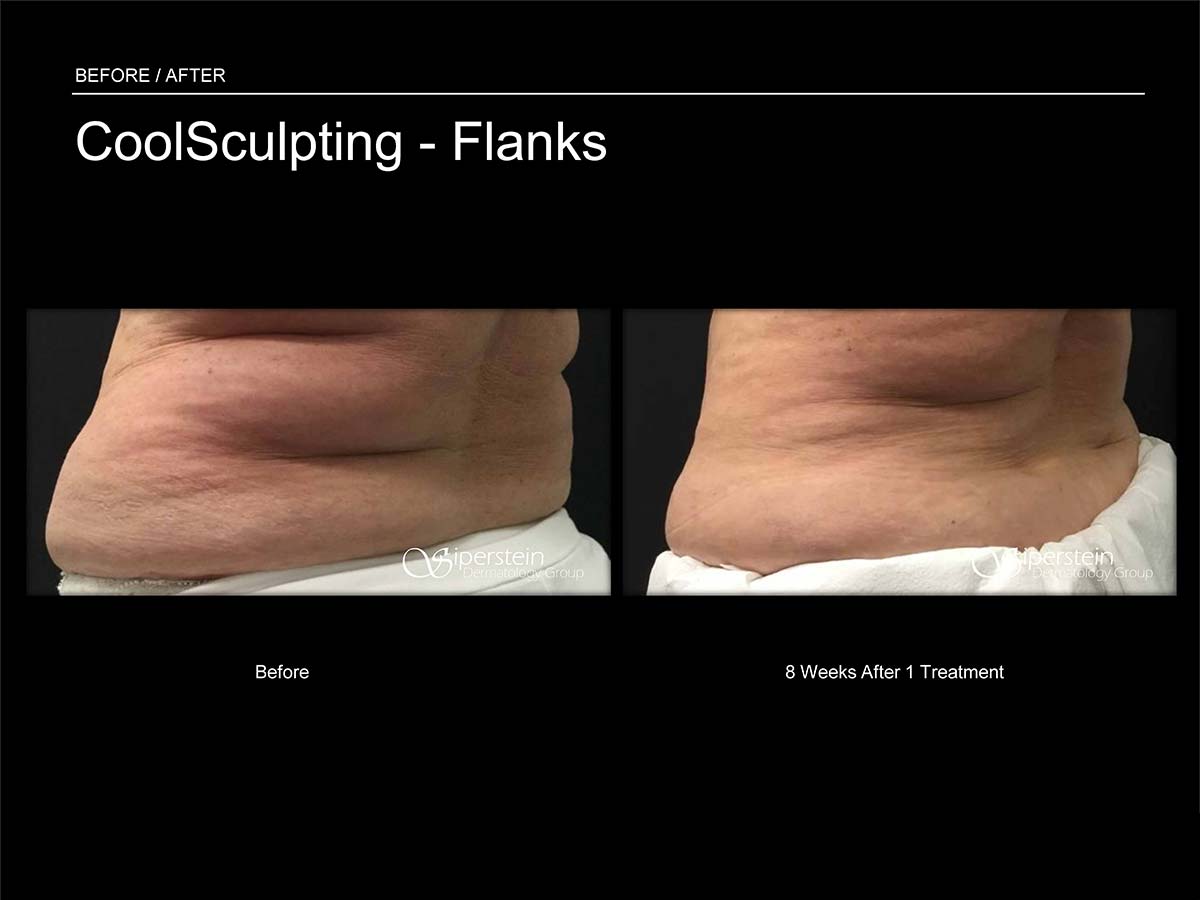 CoolSculpting - Flanks and Bra Strap Area Before & After Gallery