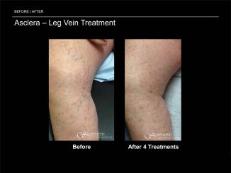 Asclera vein reduction