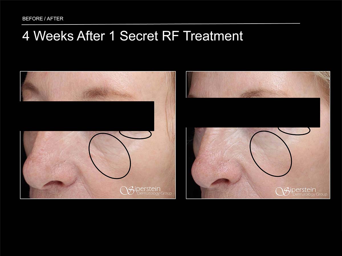 secret rf treatment under eye