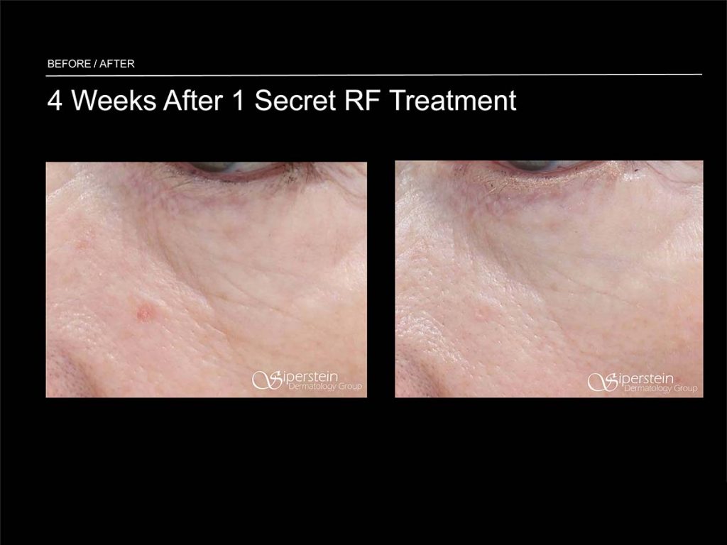 Cutera Secret Microneedling