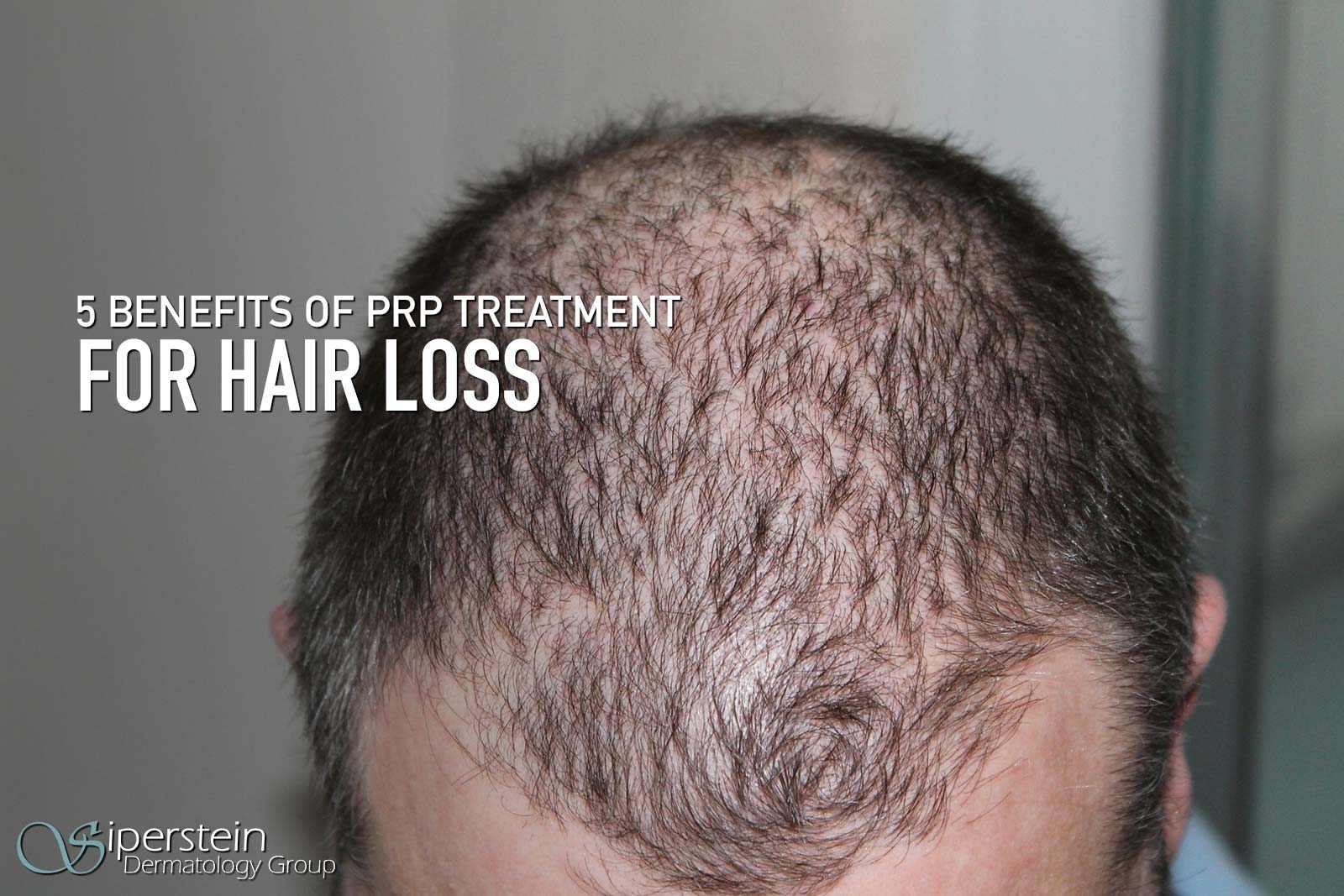 8 Benefits of PRP Hair Treatment You'll Want to Know - Aziz Aksöz