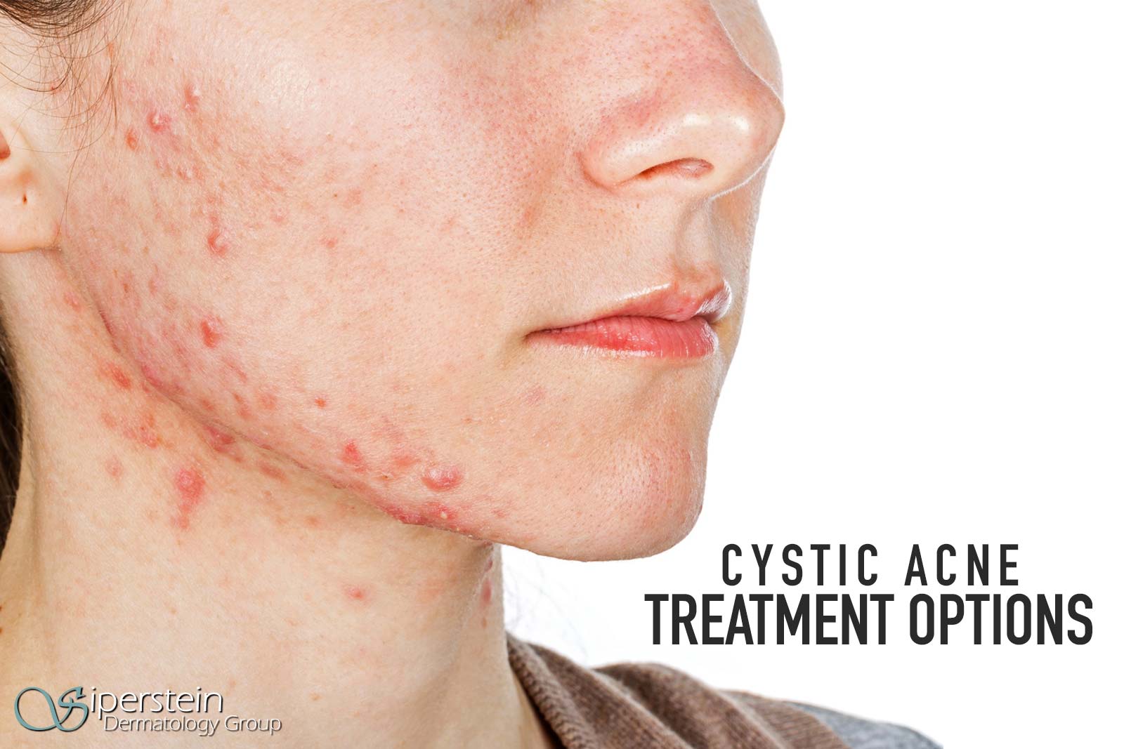 Cystic Acne Treatment