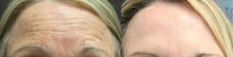 injectable-fillers-nueromodulators
