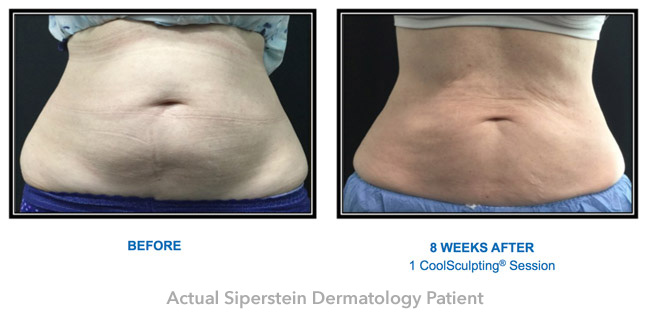 coolsculpting