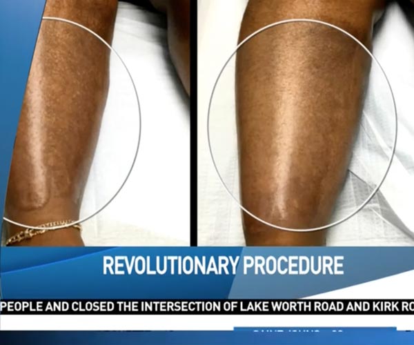 CBS PALM BEACH revolutionary procedure helps burn victim
