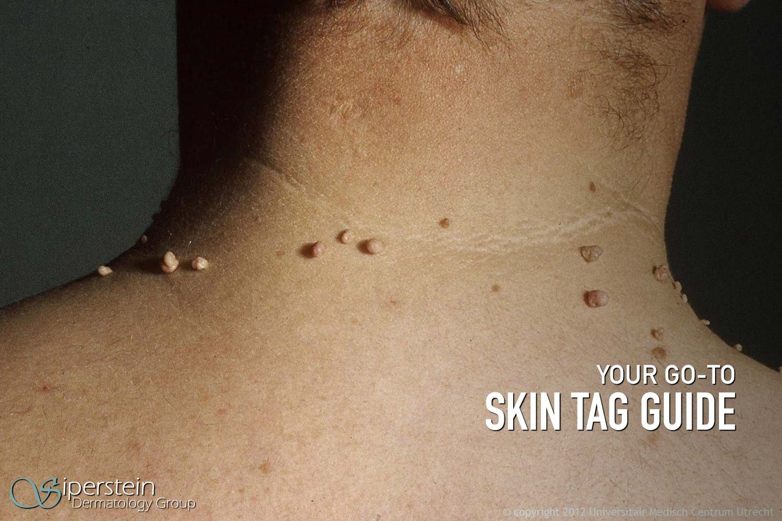 Skin tag