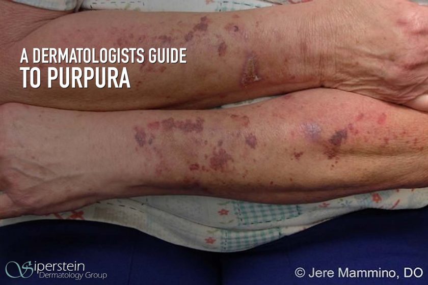 Purpura