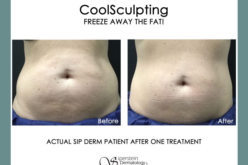 Coolsculpting Before and After Images - stomach fat