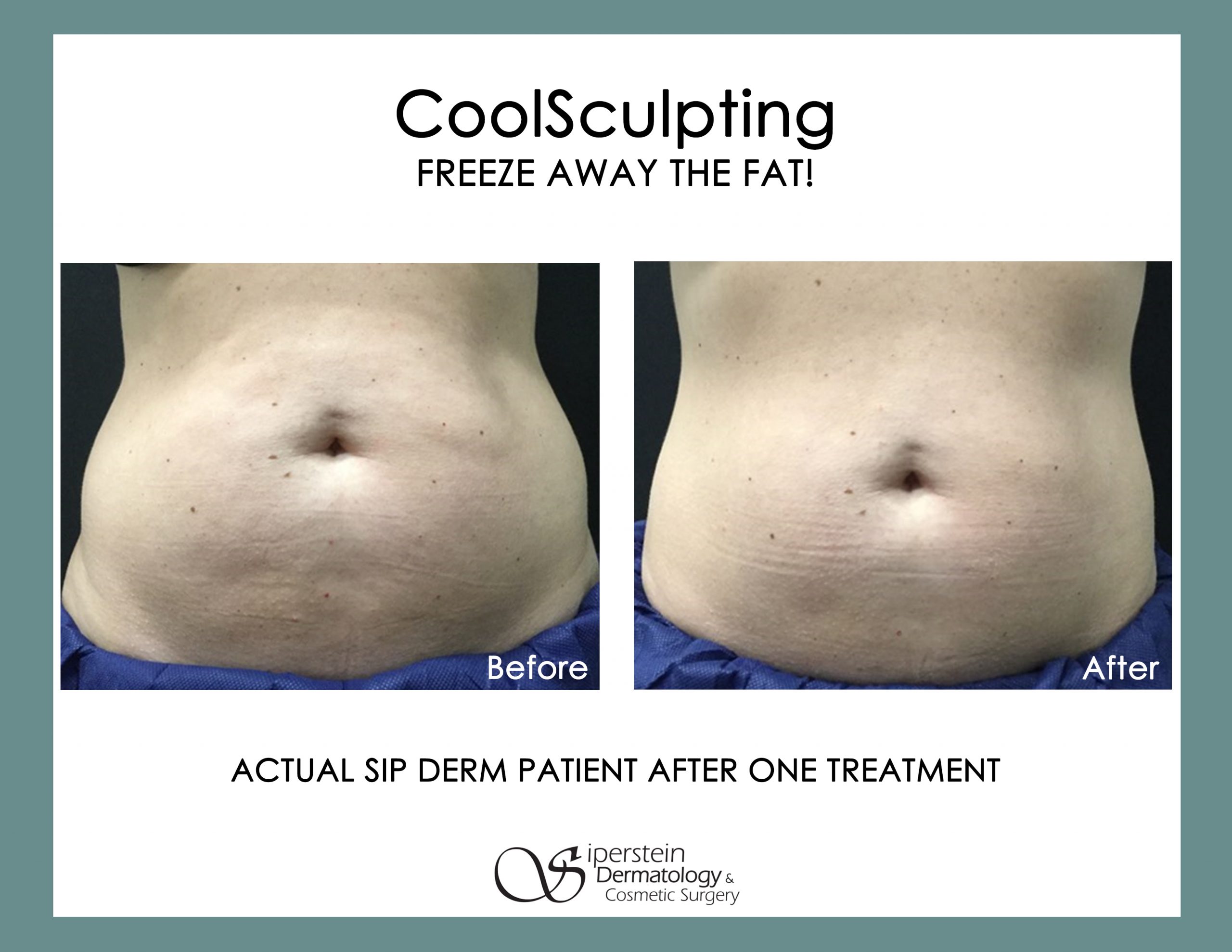 CoolSculpting before and after results from real patients