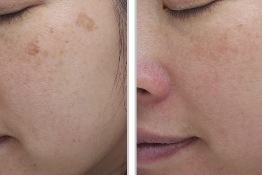 Interested in Radiant Skin? The Moxi Laser Can Help! - Siperstein