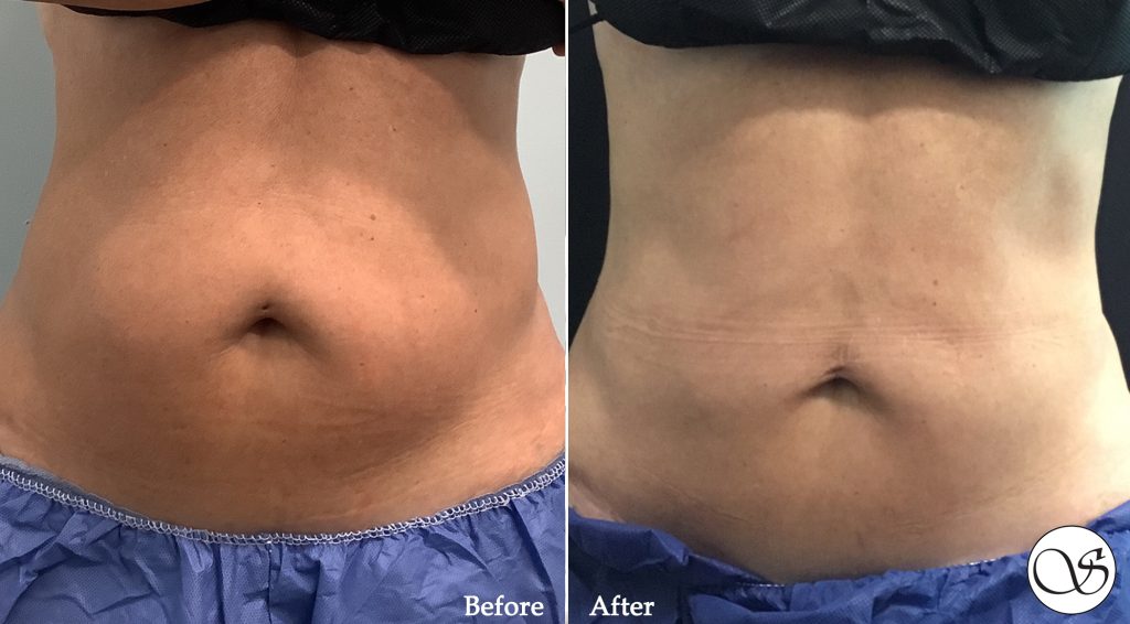CoolSculpting before and after