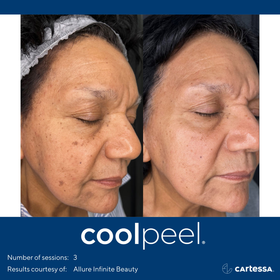 CoolPeel Siperstein Dermatology Group