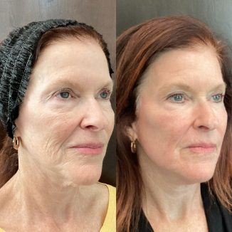 coolpeel-before-and-after